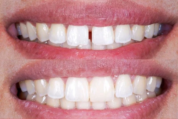 Dientes separados diagnóstico y tratamiento