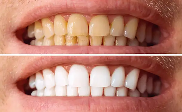 ¿Cómo prevenir manchas dentales?
