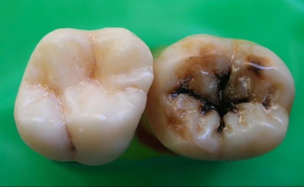 Etapas de la caries dental