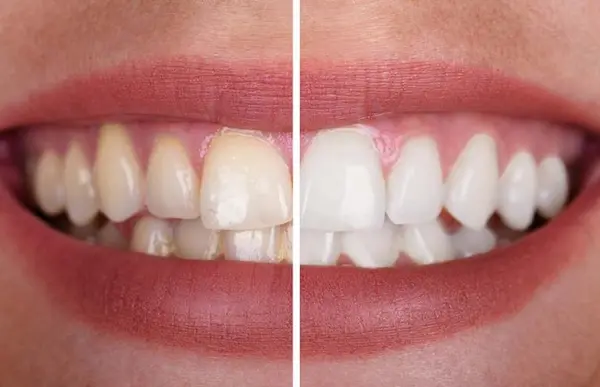 Los 15 alimentos que más manchan los dientes y afectan tu sonrisa en 2026