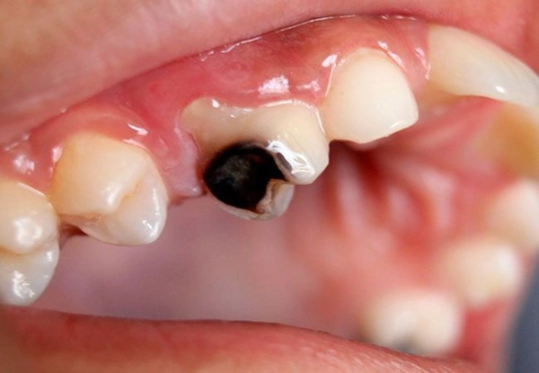 ¿Cómo prevenir la caries dental?