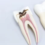 ¿Qué es la caries dental y por qué aparece?