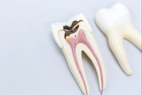 ¿Qué es la caries dental y por qué aparece