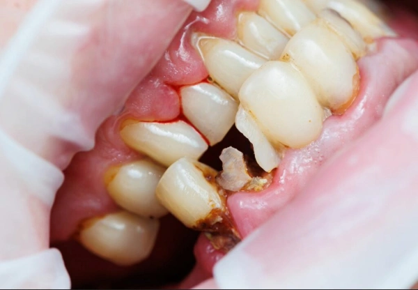 ¿Qué es la caries dental?