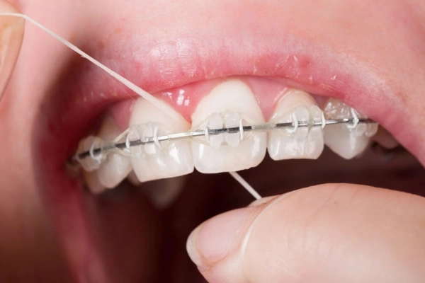 Errores comunes al usar el hilo dental y cómo evitarlos