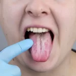 10 causas de la lengua blanca