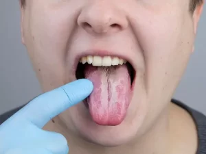 10 causas de la lengua blanca