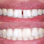 Dientes separados: diagnóstico y tratamiento
