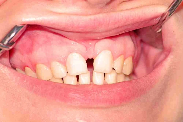 ¿Cuáles son los tratamientos para los dientes separados?