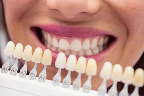 ¿Qué son las carillas dentales y para qué sirven?