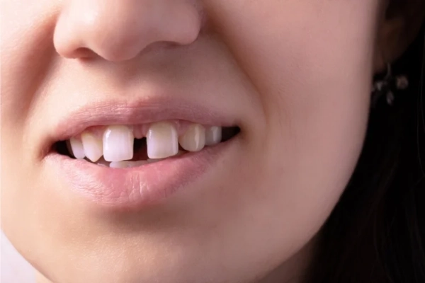 ¿Qué son los dientes separados?