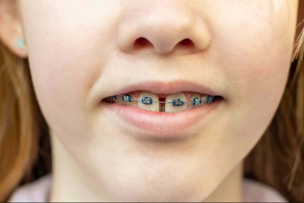 ¿Se pueden prevenir los dientes separados?